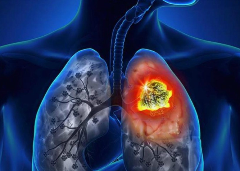 Aumento de casos de cáncer previstos para el 2020