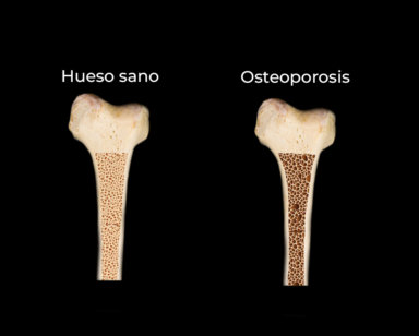 La osteoporosis es una enfermedad que adelgaza y debilita los huesos