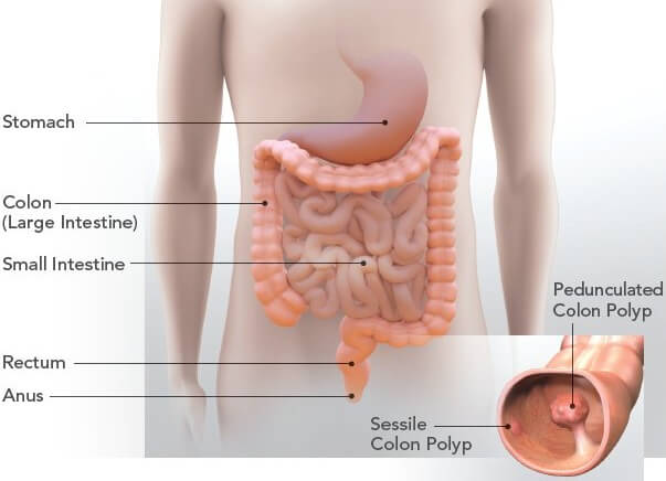 Instan a neoyorquinos a hacerse la prueba de detección de cáncer de colon