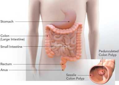Instan a neoyorquinos a hacerse la prueba de detección de cáncer de colon