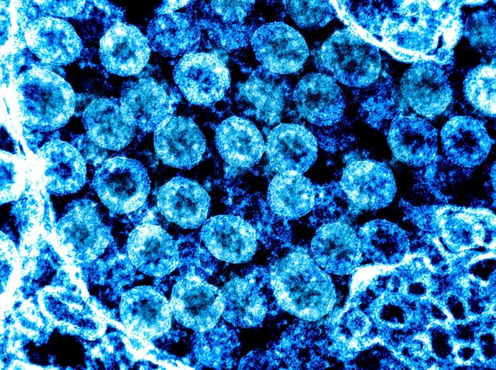 Alerta por contagios de Coronavirus en 2 restaurantes más de Suffolk