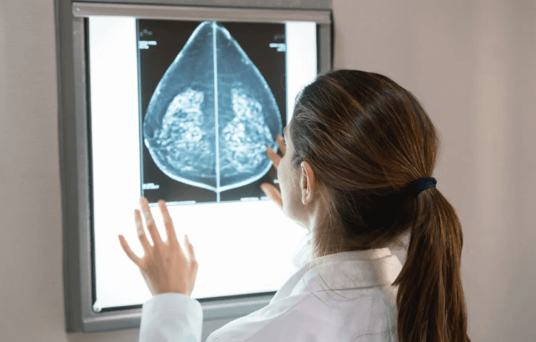Impacto de la inteligencia artificial (IA) en el diagnostico del cáncer de mama