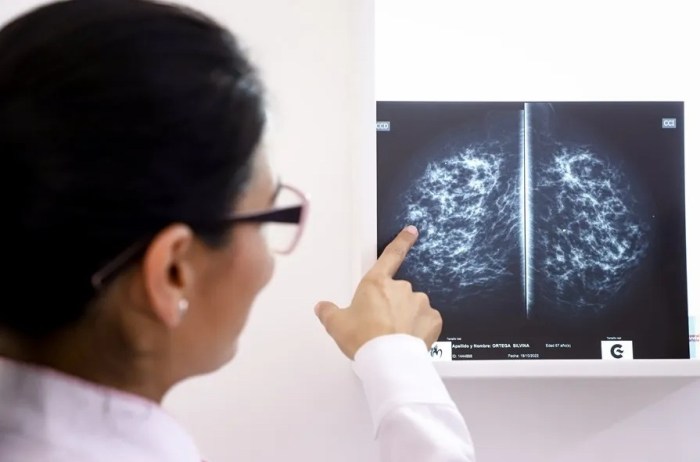 Consorcio contra el cáncer abordará en Long Island las barreras de la atención oncológica