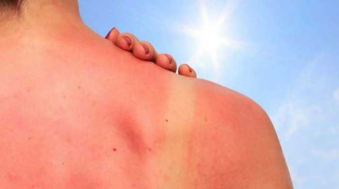 Cinco dolencias en temporada de verano que más vale prevenir que curar