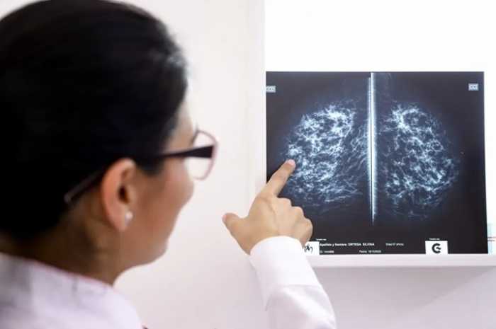 Medidas a tomar para reducir el riesgo de cáncer de mama