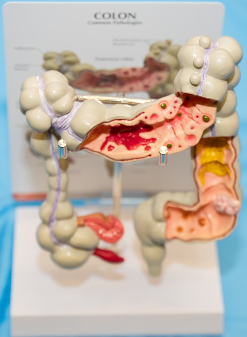 Fomentan la prevención, detección y tratamiento del cáncer colorrectal en NYC y Long Island