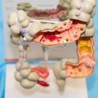 Fomentan la prevención, detección y tratamiento del cáncer colorrectal en NYC y Long Island